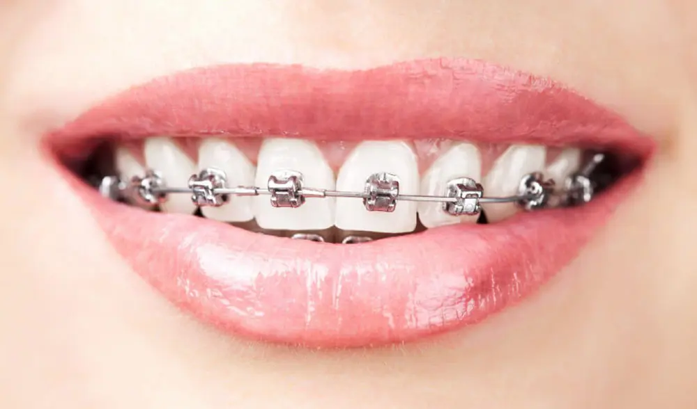 Self-ligating metal braces have a higher price than usual