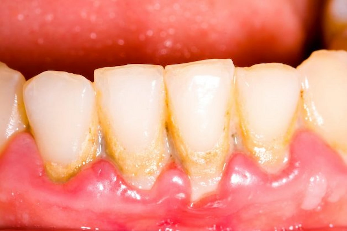 Cao răng là các mảng bám trên bề mặt răng do các mảng bám thức ăn còn sót trên răng sau đó bị oxy hóa