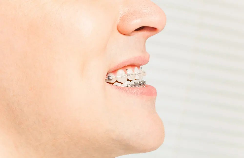 Niềng răng hàm dưới chỉ có thể cải thiện trường hợp móm nhẹ