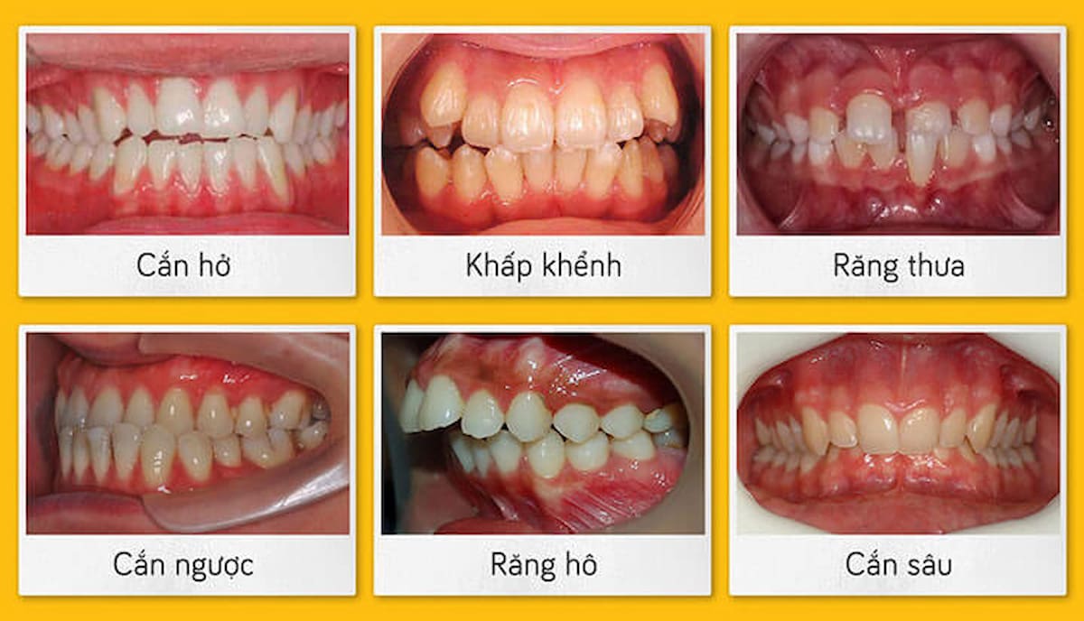 Niềng răng bằng khay trong suốt có tác dụng khắc phục tình trạng hô, móm mang lại hàm răng đều đẹp