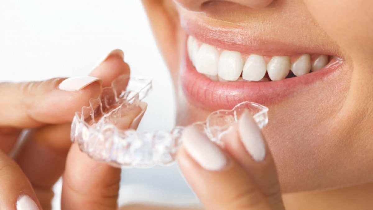 Đeo hàm duy trì sau niềng răng có cần thiết không?