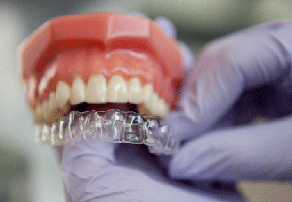 Niềng răng trong suốt có tác dụng gì mà được nhiều người lựa chọn?