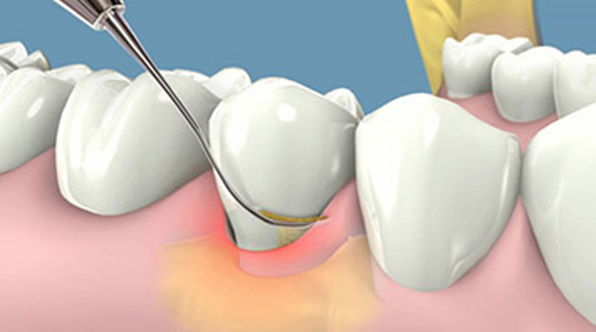 Sau khi lấy cao răng bao lâu thì được ăn và những điều cần lưu ý sau khi lấy cao răng