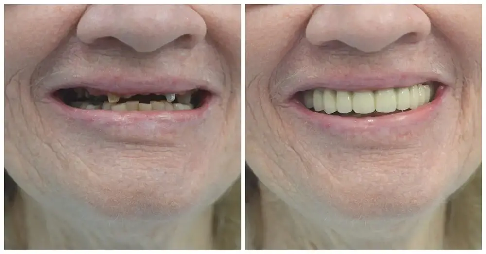 Bọc răng sứ khôi phục răng đã mất, cải thiện khả năng ăn nhai