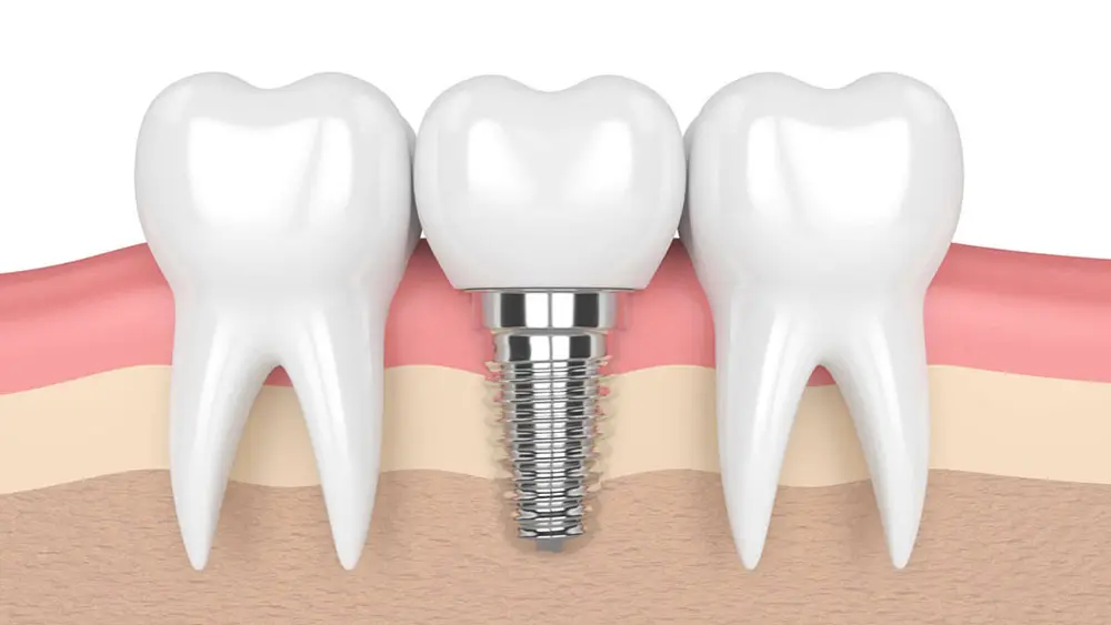 Các bộ phận cấu tạo nên răng giả implant