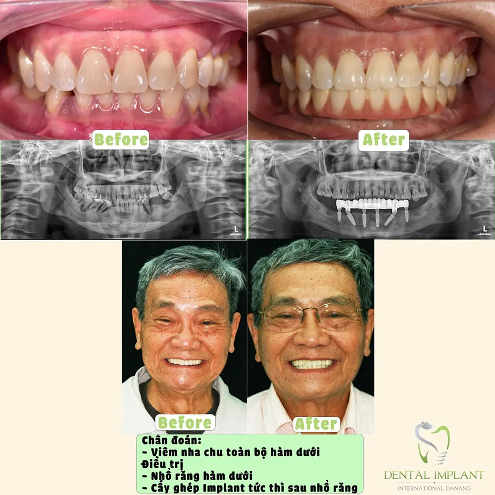 Dental implants for the entire lower jaw at the dentist