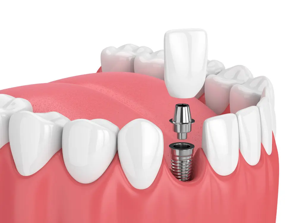 Trồng răng cấy ghép implant là phương pháp phục hình răng đã mất bằng cách cấy 1 trụ titan vào xương hàm