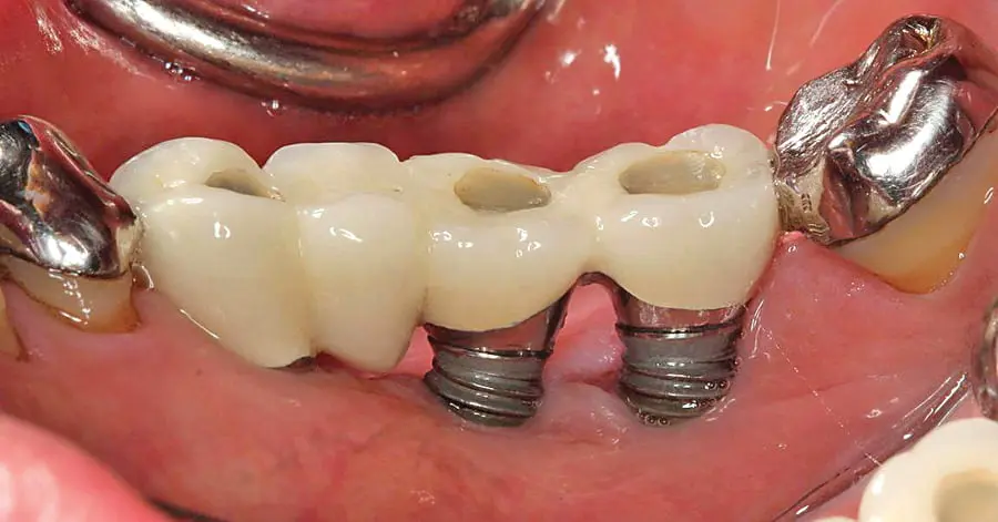 Cấy ghép implant ở nha khoa kém uy tín có thể gây ra nhiễm trùng răng
