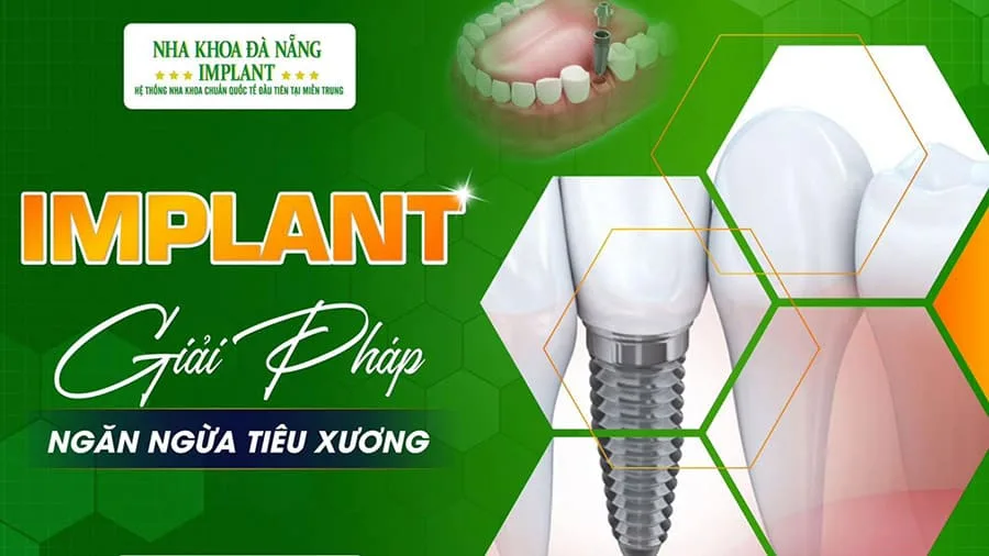 Trồng răng implant all on 6 là gì? Chi phí thực hiện có đắt không?
