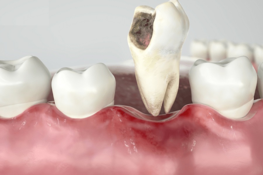 Mẻ răng có sao không? Cách khắc phục mẻ răng là gì?