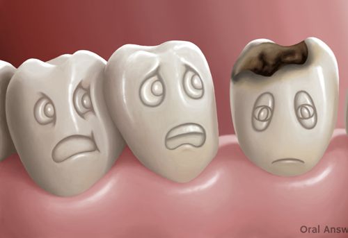 Răng bị sâu không nhổ có được không? Sâu răng có tự khỏi không?