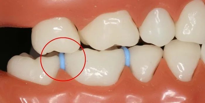 Nuốt dây thun niềng răng có sao không? Cách xử lý?