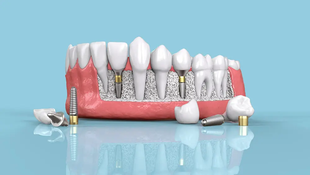 There are many methods of implanting lower teeth