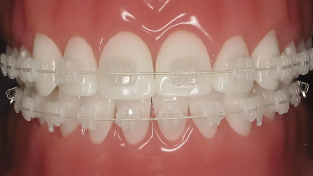 Ceramic braces are highly aesthetic, creating confidence for patients