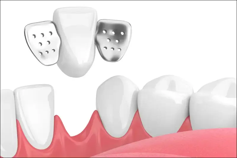 Fixed dental implants with veneered porcelain bridges