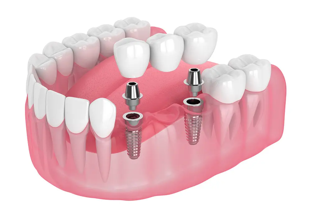 This method is a combination of implants and porcelain bridges