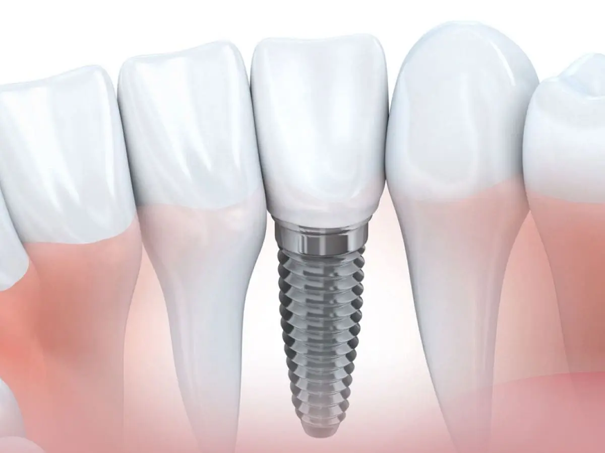 Dental implants help preserve real teeth