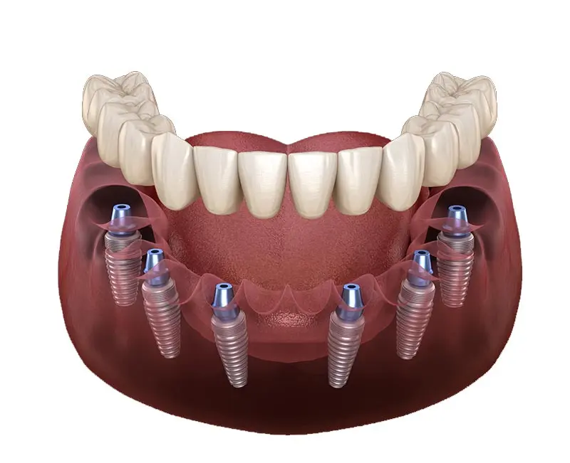 Phương pháp trồng răng Implant All On 6 là kỹ thuật cấy 6 trụ cho mỗi hàm nhằm phục hình răng cho bệnh nhân nhiều răng liên tiếp tại hàm trên hoặc dưới