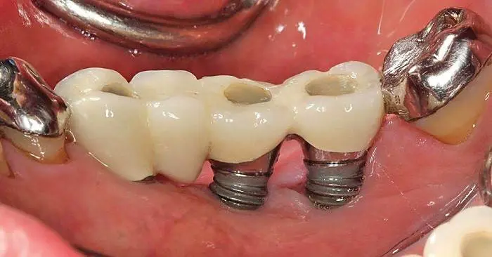 Trồng răng implant giá rẻ kém chất lượng có thể gây ra nhiễm trùng