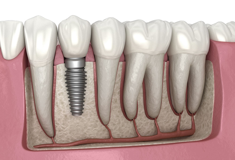 Trồng răng implant là dịch vụ phục hình nha khoa, khôi phục lại một hoặc nhiều răng đã mất, cải thiện thẩm mỹ và khả năng ăn nhai cho bệnh nhân