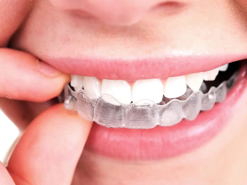Thẩm mỹ cao là ưu điểm của niềng răng invisalign