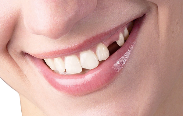 Nhổ răng số 4 và những điều bạn nên biết
