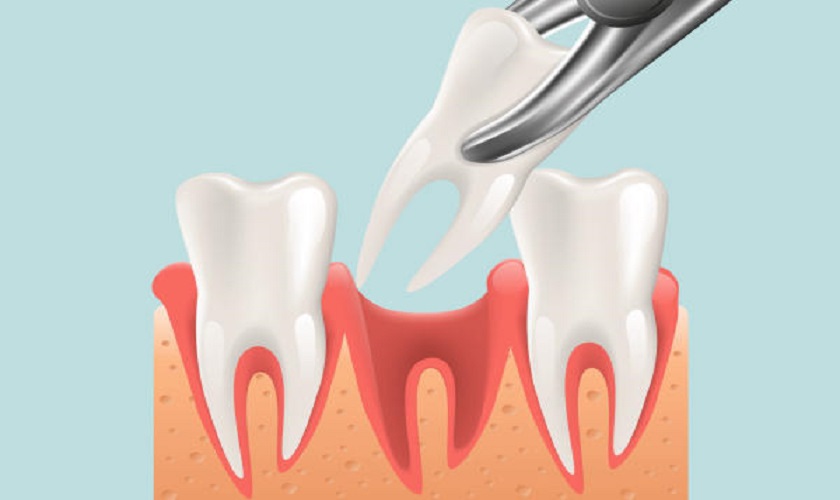 Những biến chứng sau khi nhổ răng có thể gặp phải và cách phòng ngừa