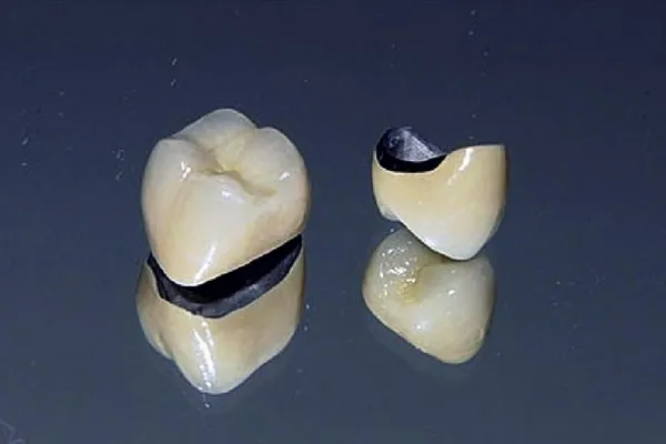 Răng bọc sứ titan có trọng lượng nhẹ nên thường được sử dụng cho hàm trên và góp phần hạn chế sập cầu răng