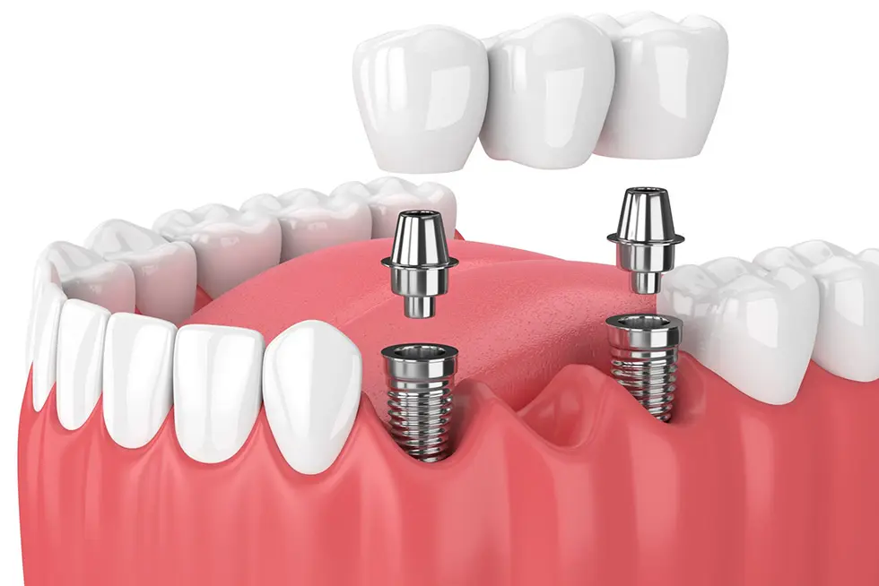 Trồng răng số 4 bằng kỹ thuật implant vừa đảm bảo được thẩm mỹ và phục hình được chức năng ăn nhai tốt.
