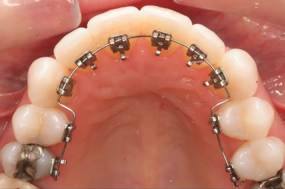 Niềng răng mặt trong là phương pháp chỉnh nha sử dụng khí cụ bao gồm mắc cài, dây cung và dây thun