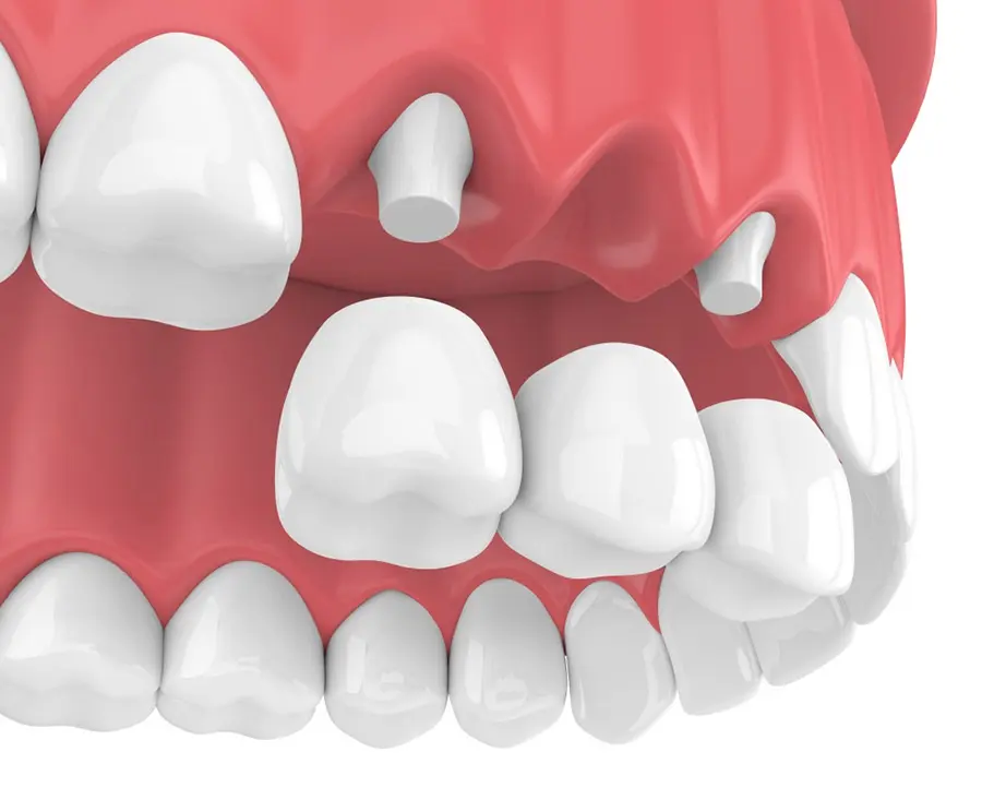 Trồng răng cửa bằng phương pháp bắc cầu răng sứ