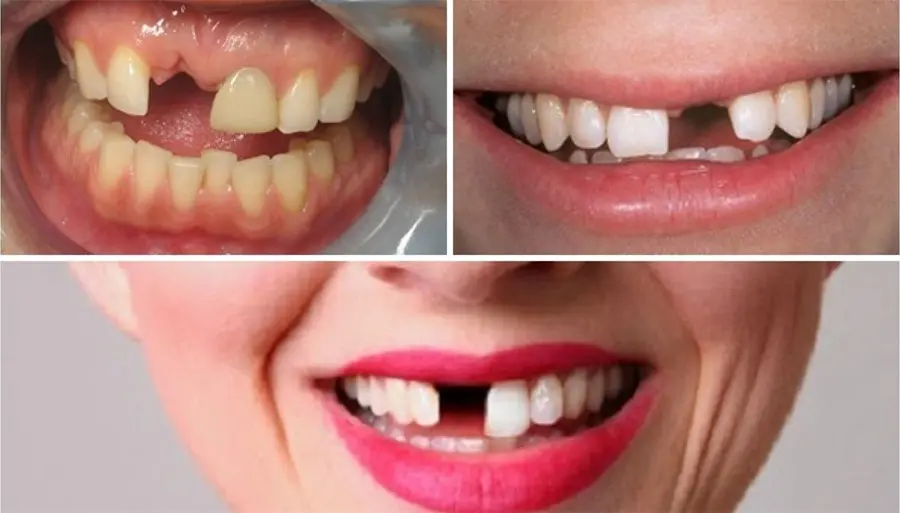 Mất răng cửa gây ảnh hưởng nhiều đến cuộc sống