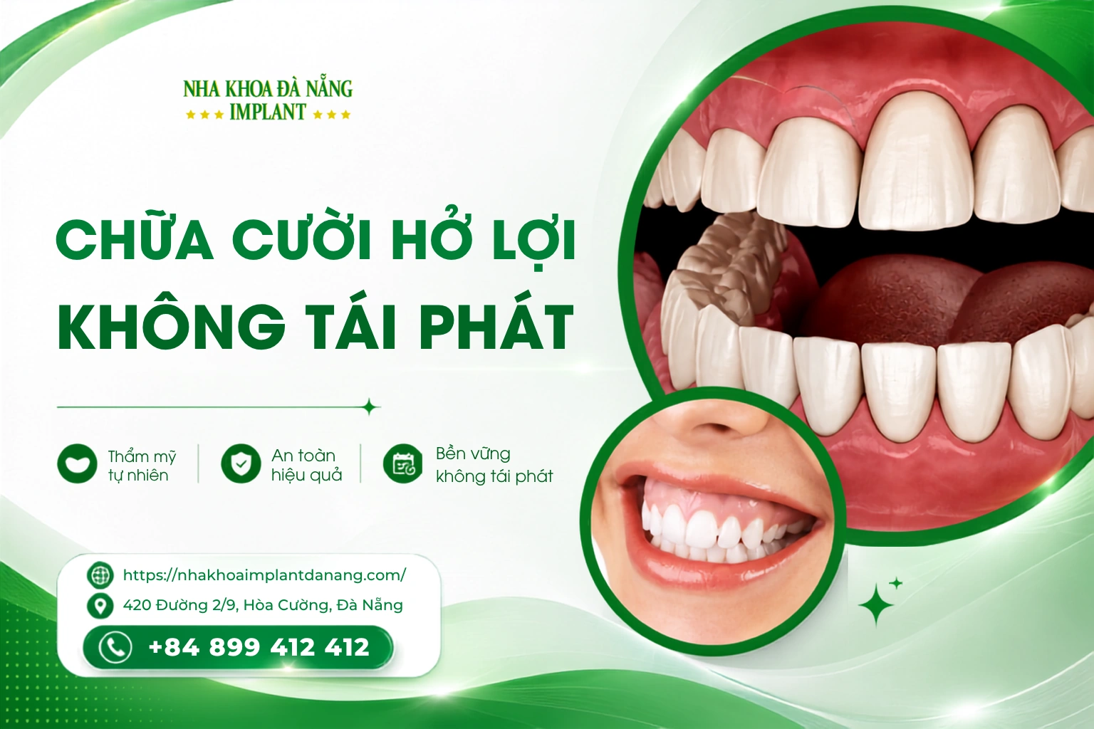 Chữa cười hở lợi không tái phát
