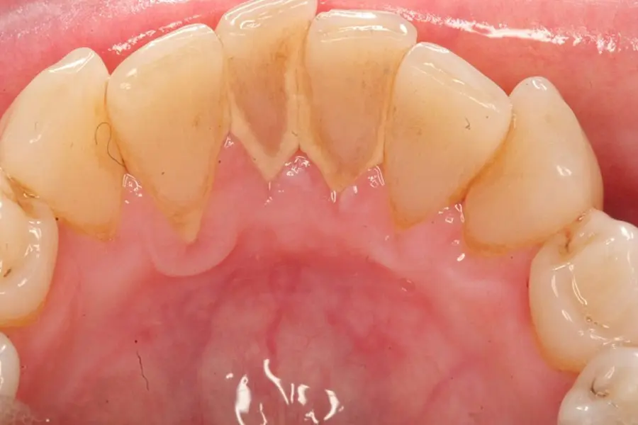 Tình trạng cao răng bám dày không thể loại bỏ bằng muối