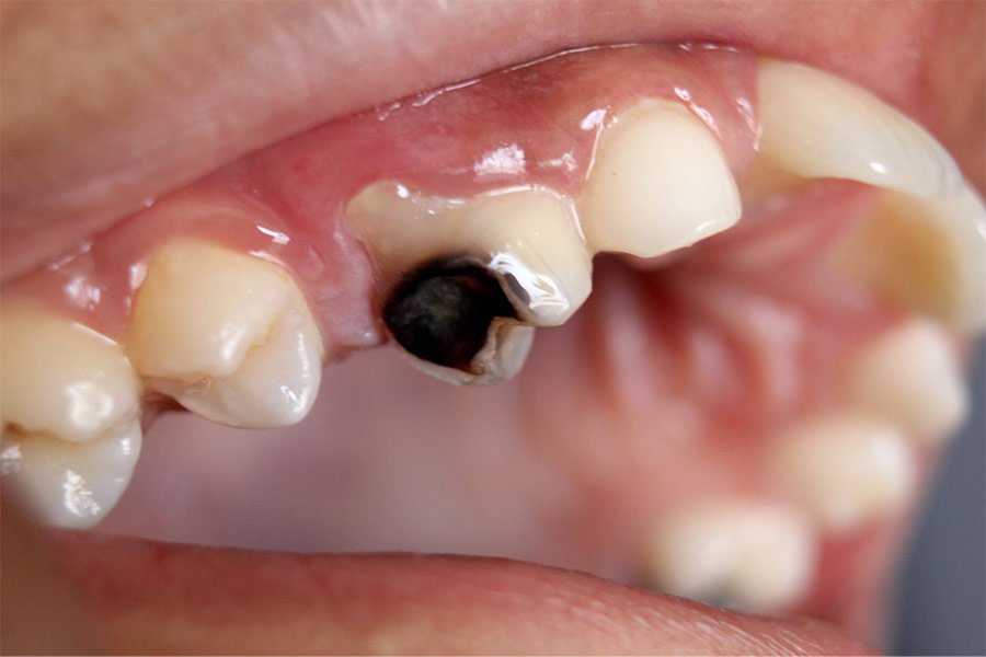 Sự thật về con sâu răng và 2 cách điều trị sâu răng hiệu quả