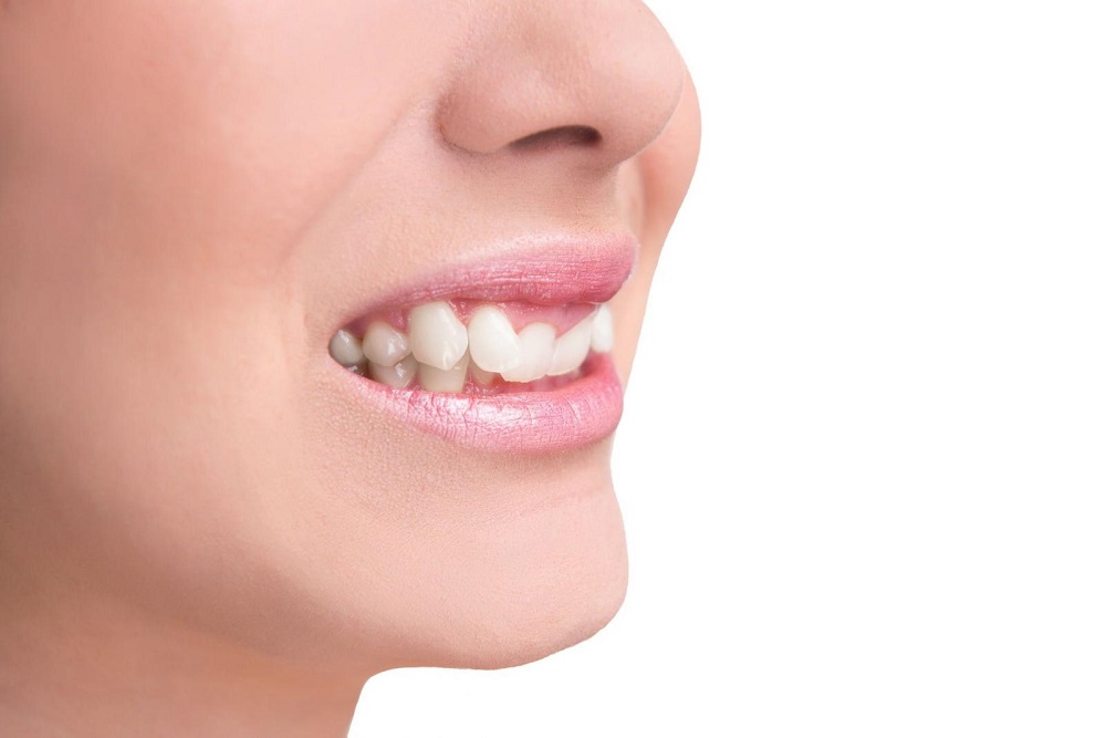 Niềng răng có giữ răng khểnh được không? Niềng răng khểnh bằng phương pháp nào nhanh chóng?