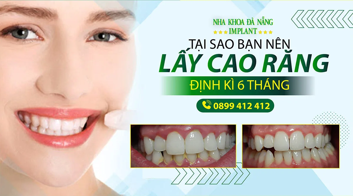 Giá lấy cao răng bao nhiêu? Giải đáp mọi thắc mắc về cao răng