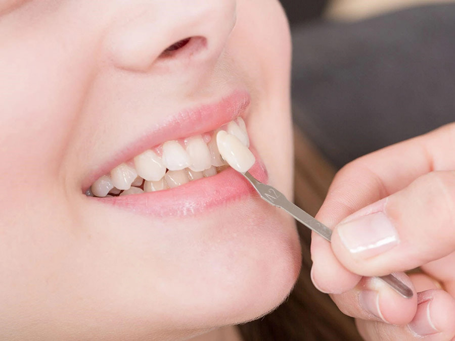 Ưu điểm của bọc răng sứ thẩm mỹ tạo răng dáng thỏ là đem lại tính thẩm mỹ rất cao, độ bền chắc
