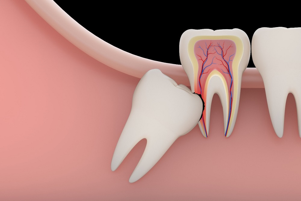 Nhổ răng khôn ăn gì giảm đau nhanh lành?