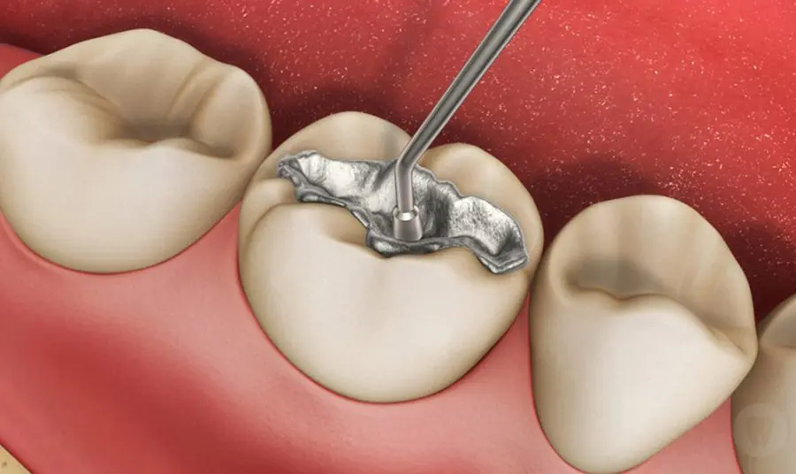 Trám răng với vật liệu Amalgam giá rẻ