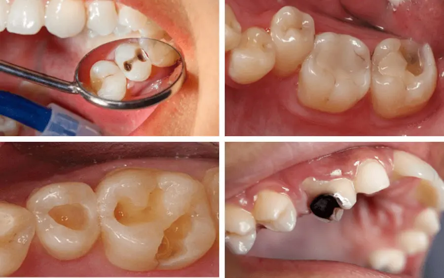 Trám răng bao nhiêu tiền phụ thuộc vào mức độ sâu, sứt mẻ của răng
