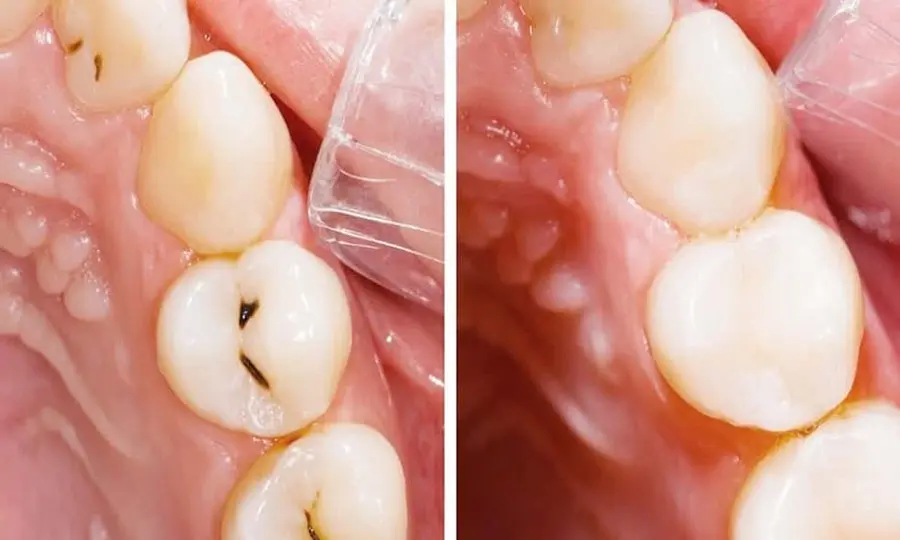 Trường hợp răng sâu nhẹ trước và sau trám răng