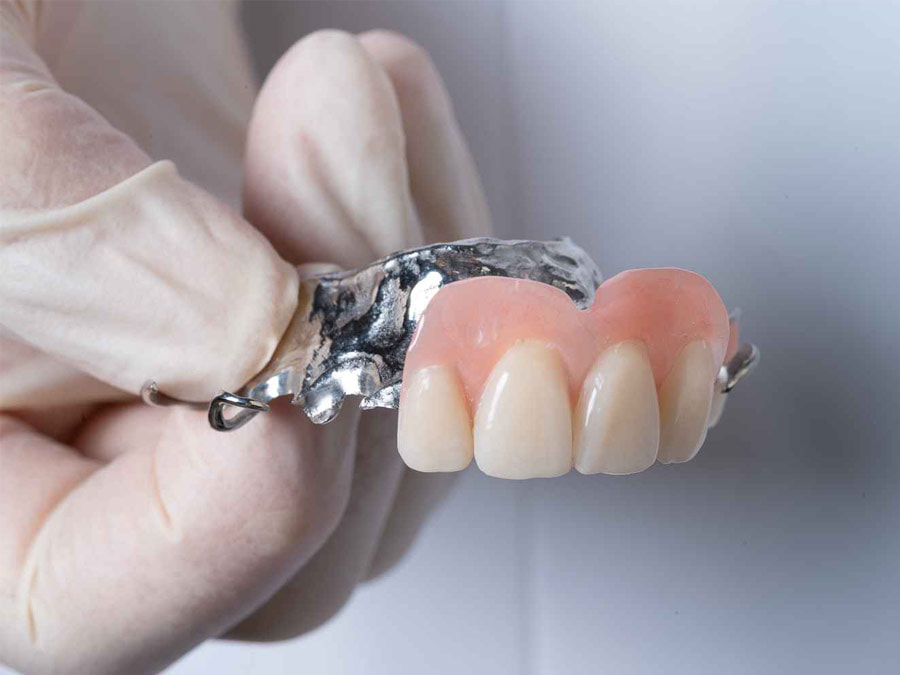 Trồng răng cửa tháo lắp có những ưu điểm và hạn chế nào?