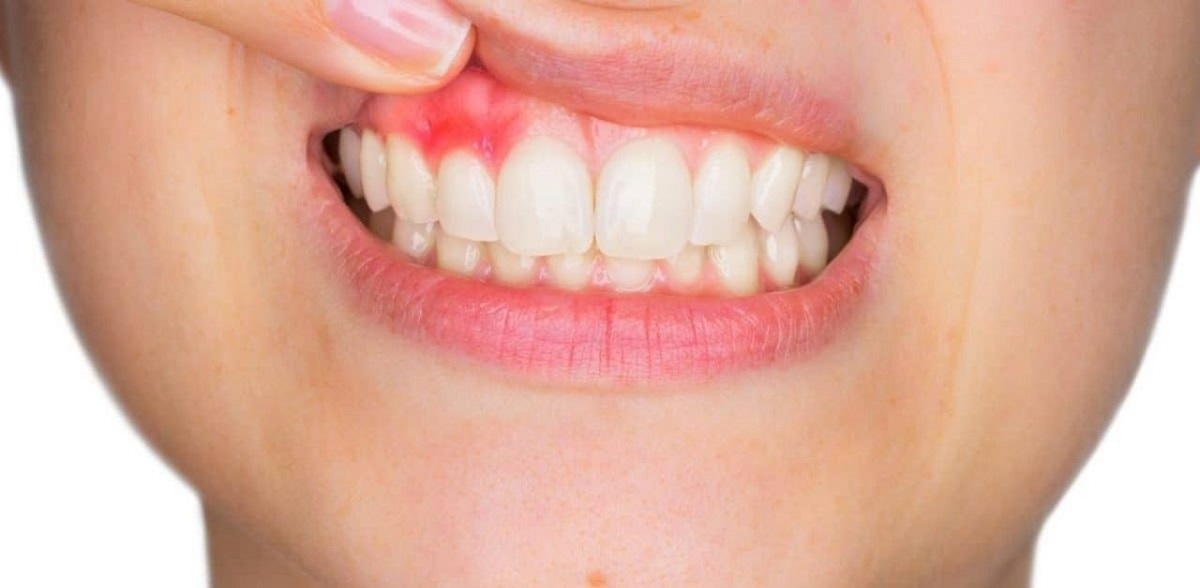 Áp xe răng là gì? Bị áp xe răng có nguy hiểm không?