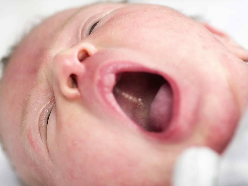 Dấu hiệu nhận biết nhiệt miệng ở trẻ sơ sinh thường rất dễ thấy