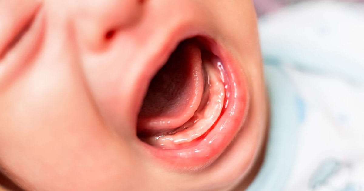 Trẻ sơ sinh bị nhiệt miệng: Nguyên nhân, dấu hiệu và cách trị hiệu quả tại nhà 2 Trẻ sơ sinh bị nhiệt miệng: Nguyên nhân, dấu hiệu và cách trị hiệu quả tại nhà