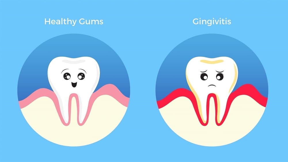 Khi nhắc đến vấn đề chảy máu chân răng là thiếu chất gì thì phải kể đến vitamin K