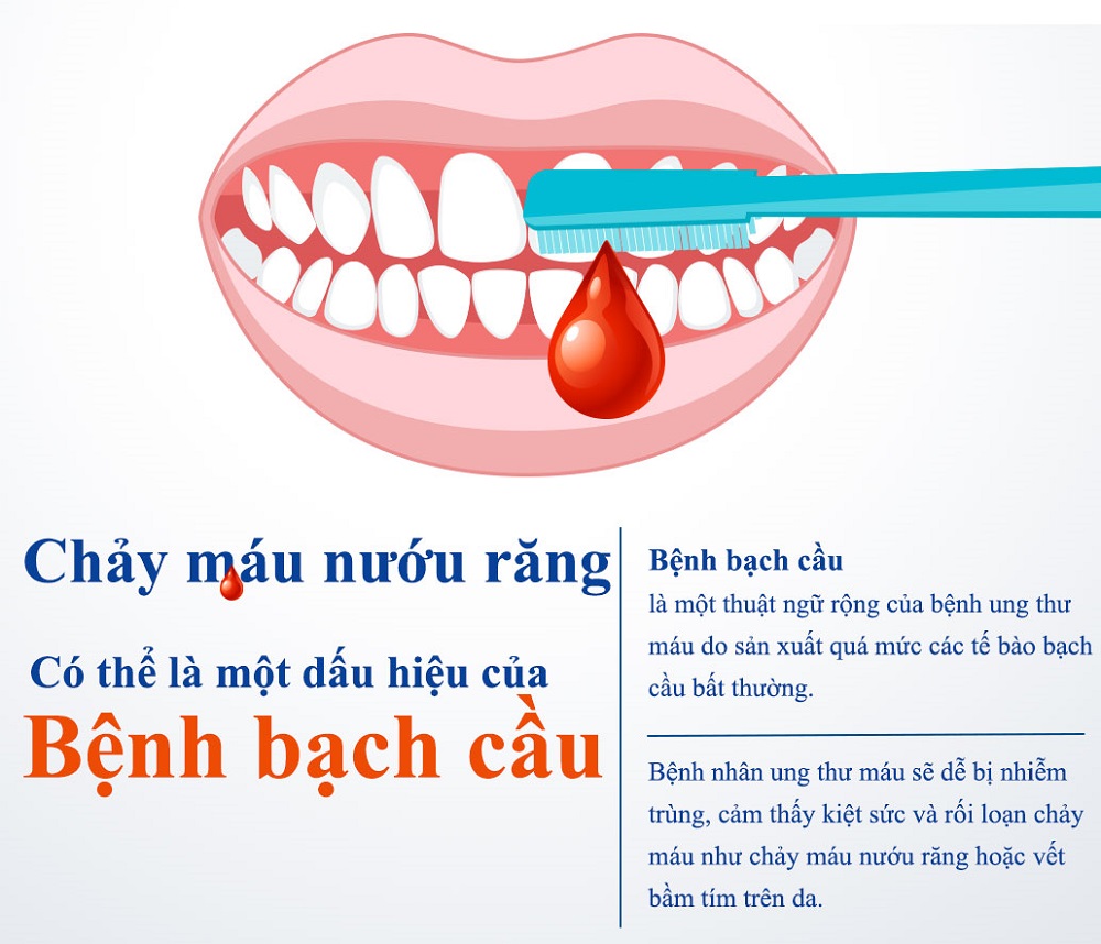 Chảy máu chân răng khi đánh răng – Khi nào cần thăm khám?