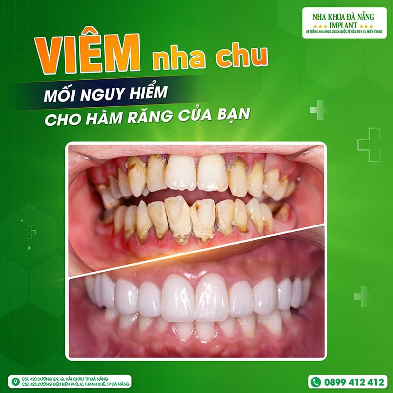 Viêm nha chu là gì? Dấu hiệu nhận biết và cách điều trị