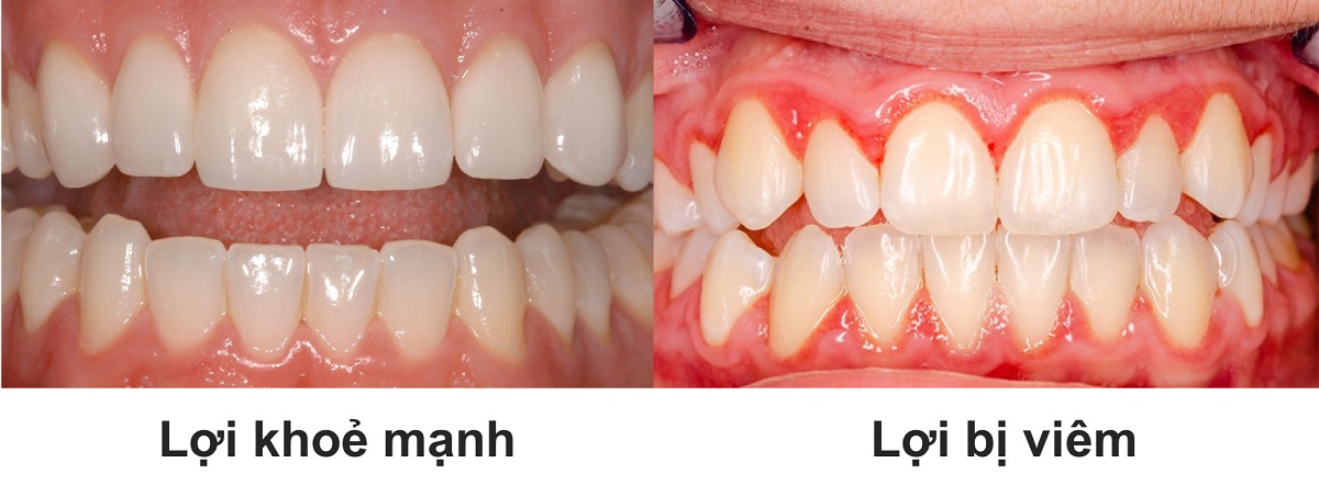 Viêm nướu răng dùng thuốc gì? Cách chữa viêm nướu chân răng tại nhà